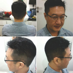non surgical hair replacement jakarta 